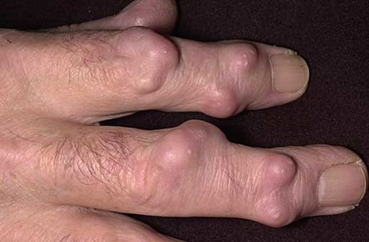 <p>solid, round, ellipsodial lesions that can extend into the dermis</p>