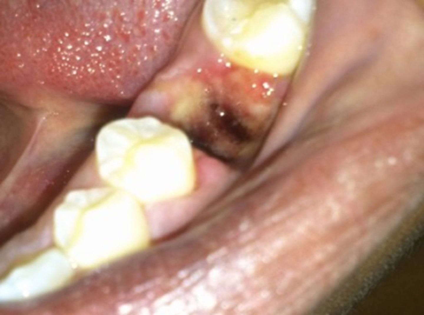 <p>- Minor infection: characterised by swelling that increases or does not resolve quickly after extraction; may be accompanied by draining pus, malaise and/or fever; needs to be seen by dentist</p><p>- Dry socket: loss/ lysis or failure of clot to form; more common in mandible because of reduced blood supply; increase in acute, localised pain after 48 hrs (2-5 days); refer to dentist</p>