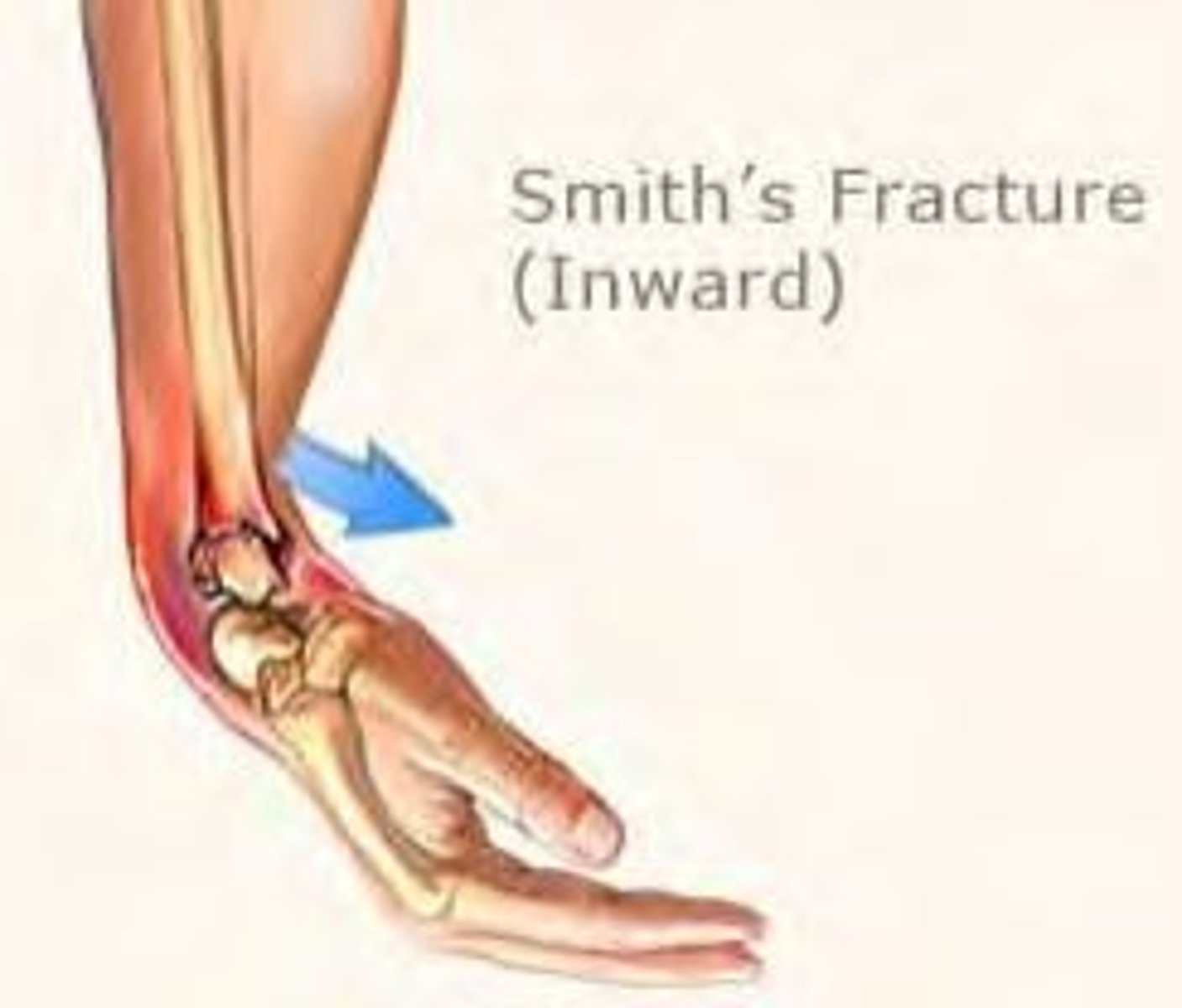<p>anterior displacement of distal radius</p>