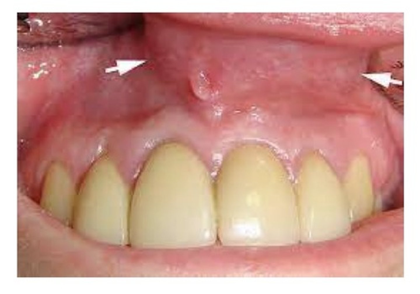 <p>A soft tissue cyst. Thought to originate from the lower anterior portion of the nasolacrimal duct. Observed in adults 40-50 years of age. 4:1 in favour of females (menopause). Salty taste.</p>