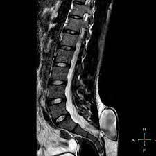 <p>a defect of the backbone (spine) and spinal cord. Before birth, the baby&apos;s spine, the spinal cord and the spinal canal do not form or close normally. most serious form of spina bifida.</p>