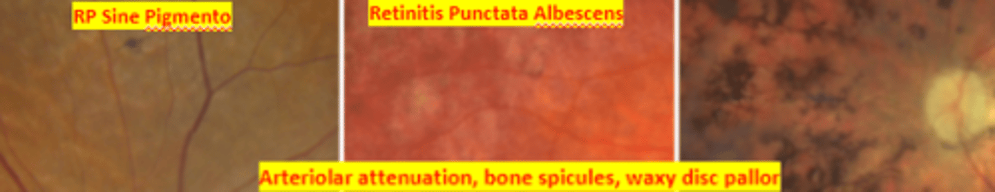 <p>ROD cone dystrophy condition characterized by genetic defects in the production of photoreceptor proteins resulting in bilateral melanin pigment clumping and subsequent early degeneration of rods and of cones in later stages due to a defect in the rhodopsin gene. Presents as loss of peripheral vision with the first symptom usually being loss of night vision. Genetic counseling and referral to low vision indicated. Long term prognosis is poor.</p>