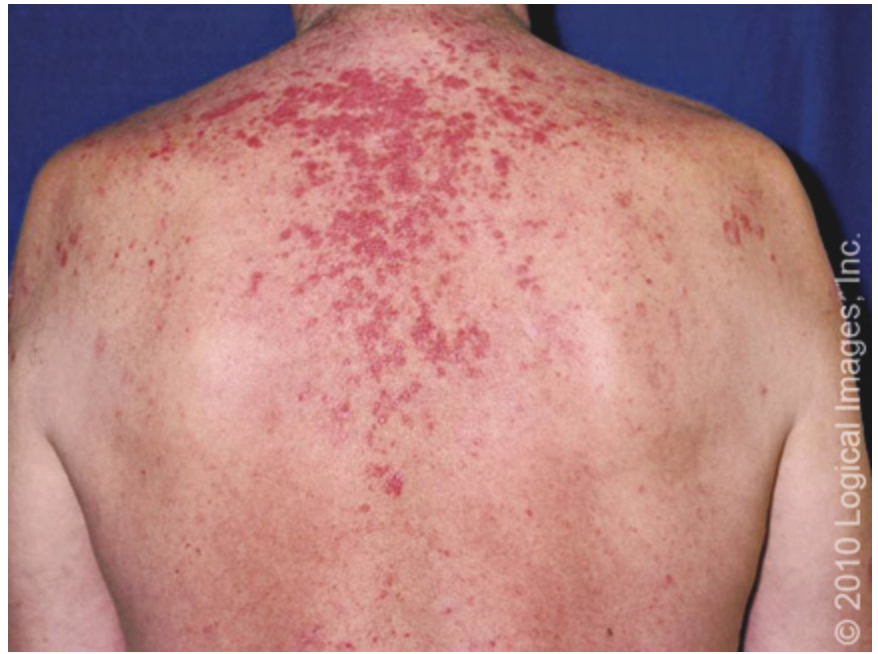 <p>What form of CLE is characterized by skin lesions triggered by sun exposure?</p>