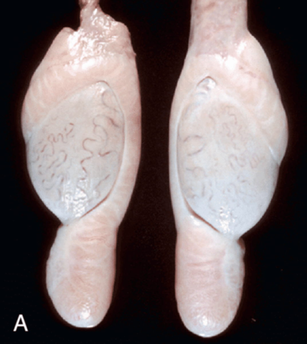 <p>Congenital or pre-puberty but often isn't observed until after puberty. → so cant diagnose until here</p>
