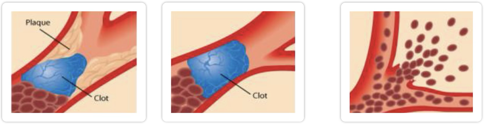 <p>Ischemic (<strong>block</strong>) stroke - 87%</p><ul><li><p>Thrombotic - plaque build up and then clot can’t get through leading to decrease blood flow</p></li><li><p>Embolic - clot from the heart that travels as far as it can before it becomes a problem</p></li></ul><p>Hemorrhagic (<strong>bleed</strong>) stroke - 13%</p>