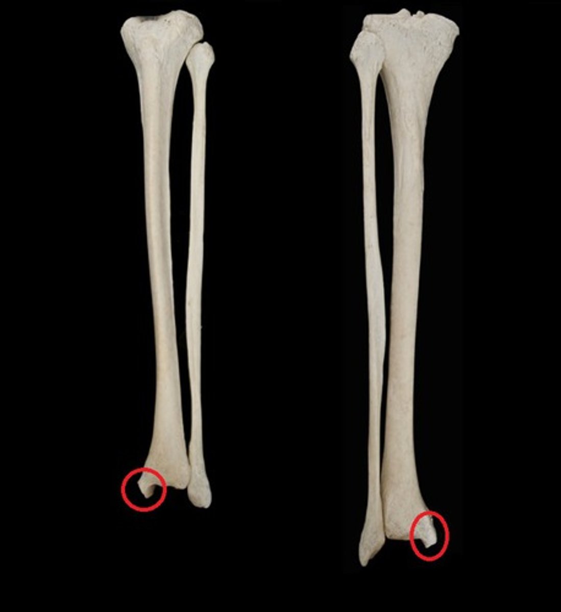 <p>medial expansion inferior to shaft</p>