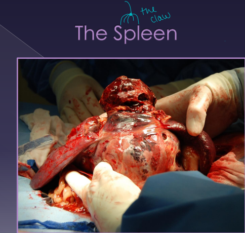 <p><span>Splenomegaly</span></p>