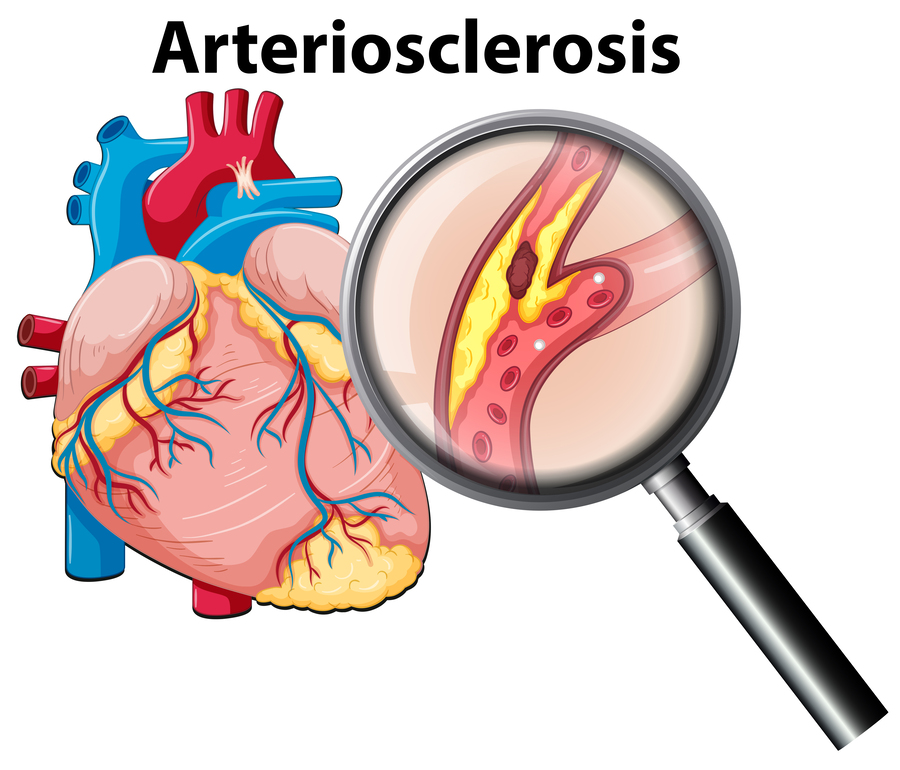 <p>Arteriosclerosis</p>