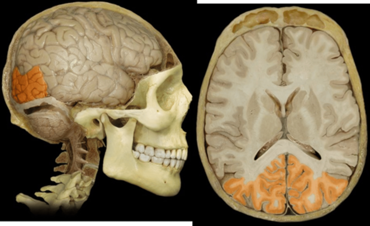 <p>on either side of calcarine sulcus</p>