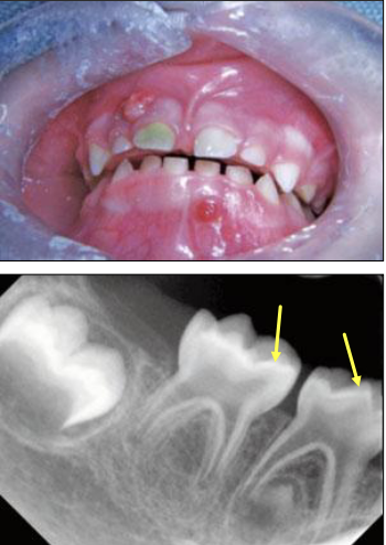 <ol><li><p>Large pulp horns extending to DEJ</p></li><li><p>Multiple non-vital teeth</p></li><li><p>Absence of caries or trauma</p></li></ol><p></p>