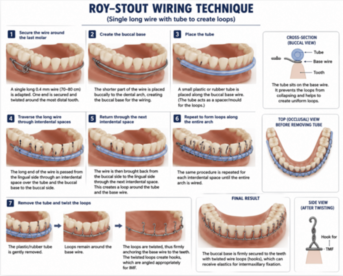 <p>0.4mm thick, 70-80cm long wire</p><p>- loop wire around most distal mandibular tooth</p><p>- short part of wire used to form buccal base</p><p>- place a small rubber tube along the base</p><p>- he long part of the wire is passed lingually to bucally through the interdental spaces</p><p>- bring the wire back from the lingual side and make loops</p><p>- remove the rubber tube and twist the loops to anchor the wire to the teeth</p><p>- twisted loops form rigid hooks - can be used for IMF</p>