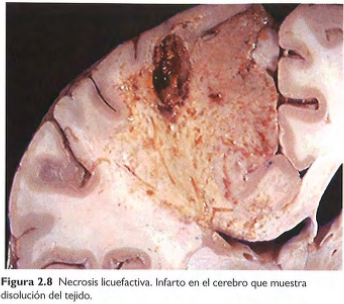 <p>-Caracterizada por digestión de células muertas, transforma el tejido en un líquido viscoso. </p><p>-En infecciones bacterianas focales y fúngicas (Los microbios estimulan los leucocitos y su liberación de enzimas)</p><p>-Hay pus (material amarillo con leucocitos) </p><p>-En muerte celular de SNC. </p>