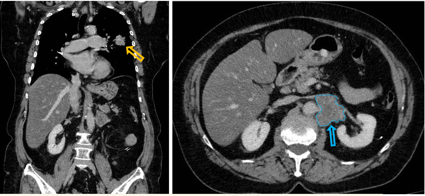 <p>Patient history: staging CT after positive chest x-ray screening </p><p>Modality: contrast-enhanced CT scan, venous phase; left – coronal reconstruction; right – axial view </p><p>Region: chest and upper abdomen </p><p>Radiologic sign: lobulated, contrast-enhancing mass in the lower lobe of the left lung (yellow arrow), contrast enhancing solid mass in the left adrenal gland with similar morphology (blue arrow) </p><p>Diagnosis: primary non-small cell lung cancer with metastasis in the left adrenal gland</p>
