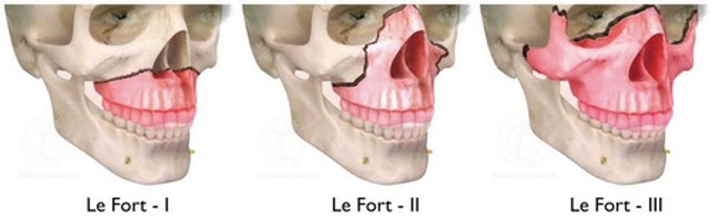 <p>Le Fort fractures types I-III</p>