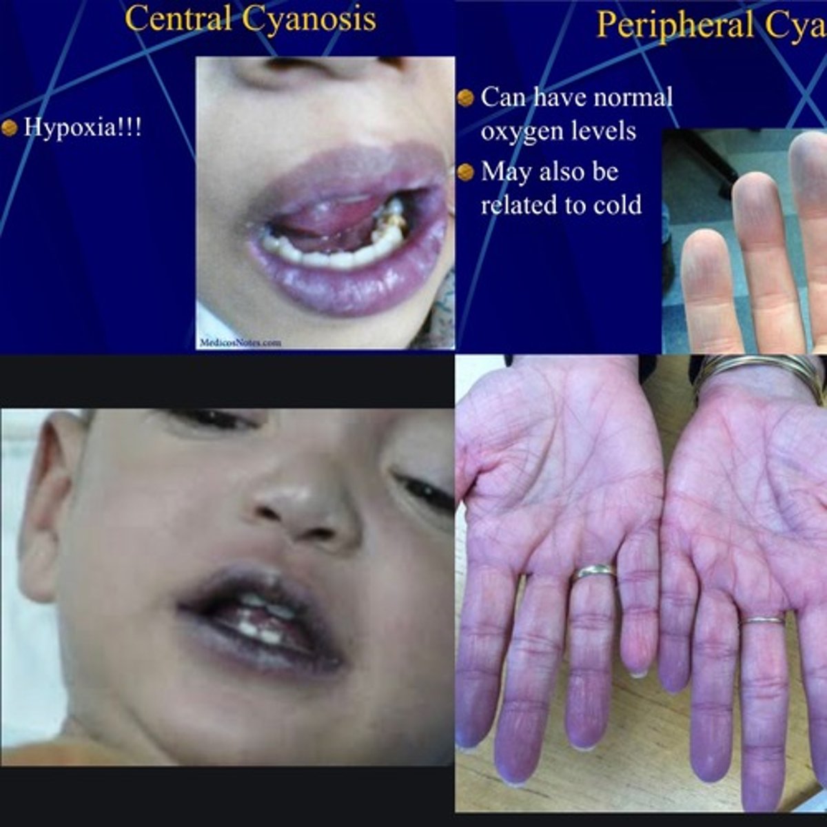 <p>- peripheral cyanosis: low peripheral perfusion (eg. low CO, peripheral vasoconstriction - eg. cold, shock)</p><p>- central cyanosis: deoxygenated hemoglobin, never normal (eg. acidosis, high CO2) => increasing CO2 &amp; low O2 => more difficult for Hgb to bind O2 molecules!!!!</p>