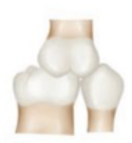 <p>what class of occlusion is this?</p>