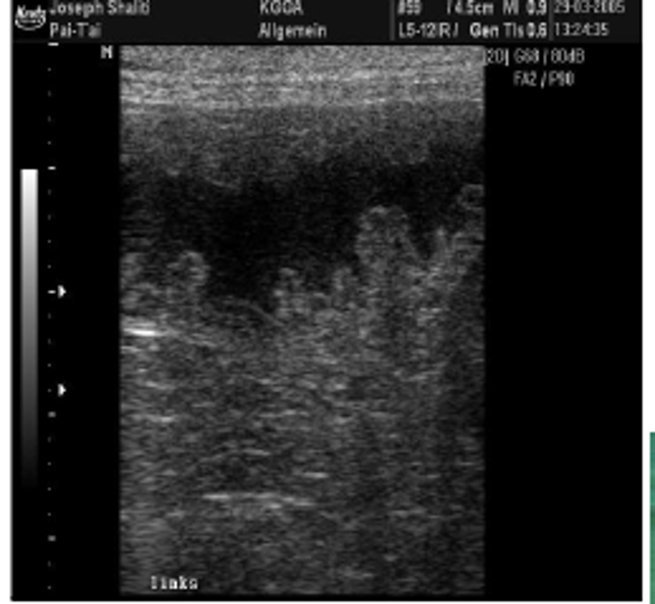 <p>ved ultralydskanning</p>