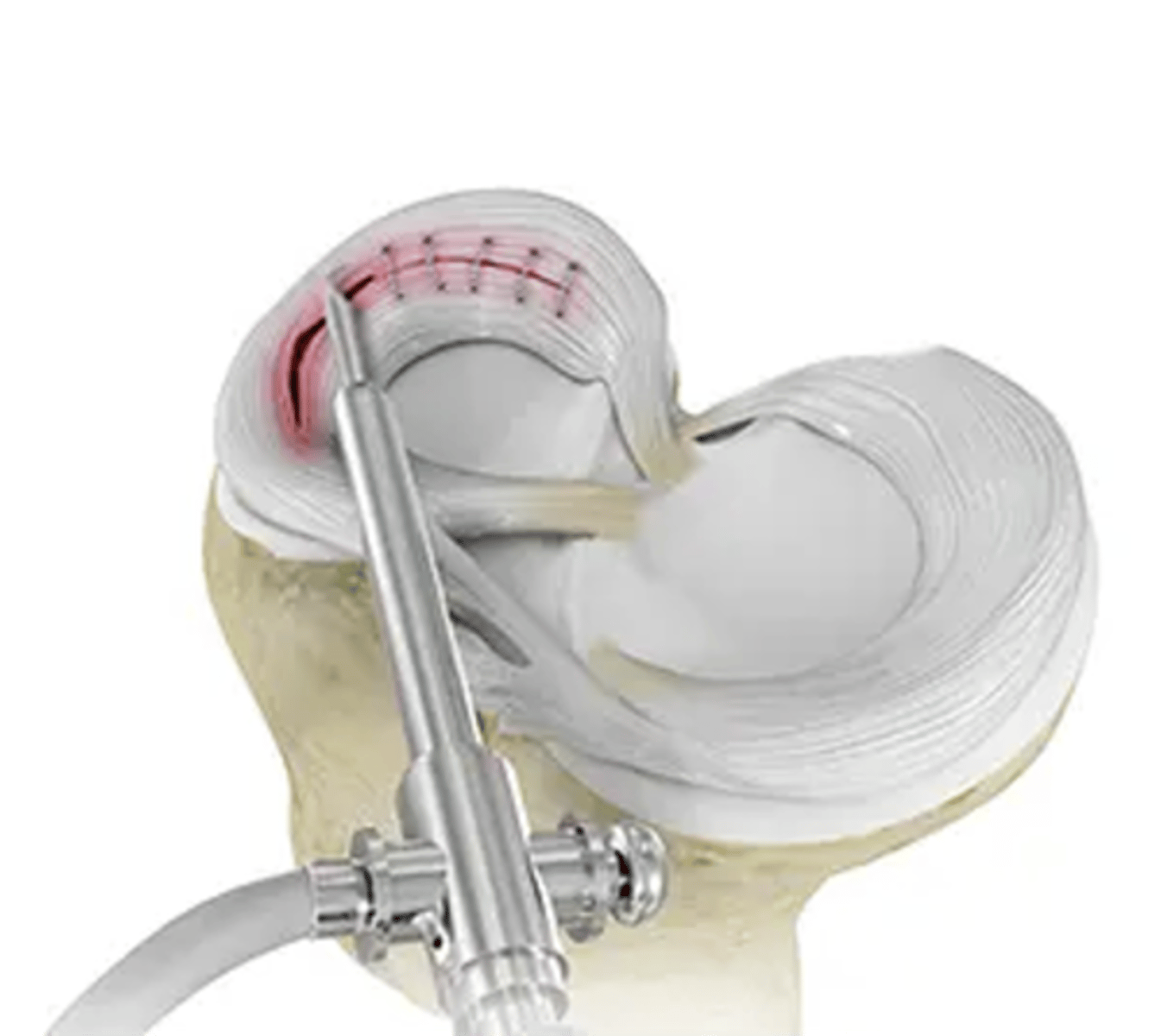 <p>Which part of the meniscus can be repaired?</p>