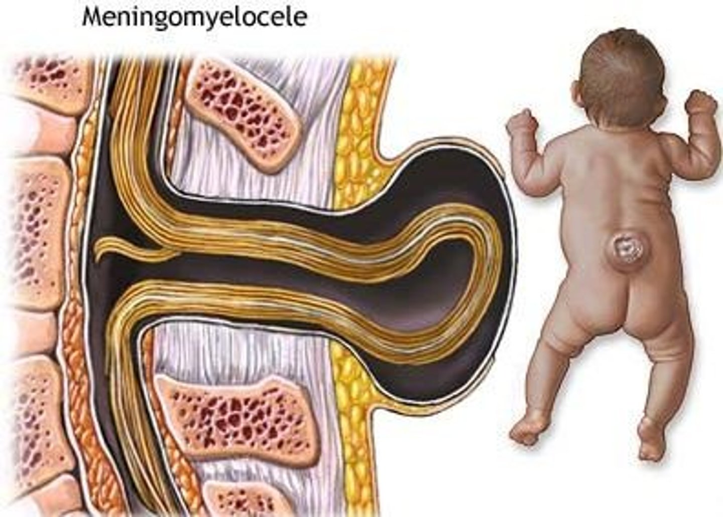 <p>Define Myelomeningocele</p>