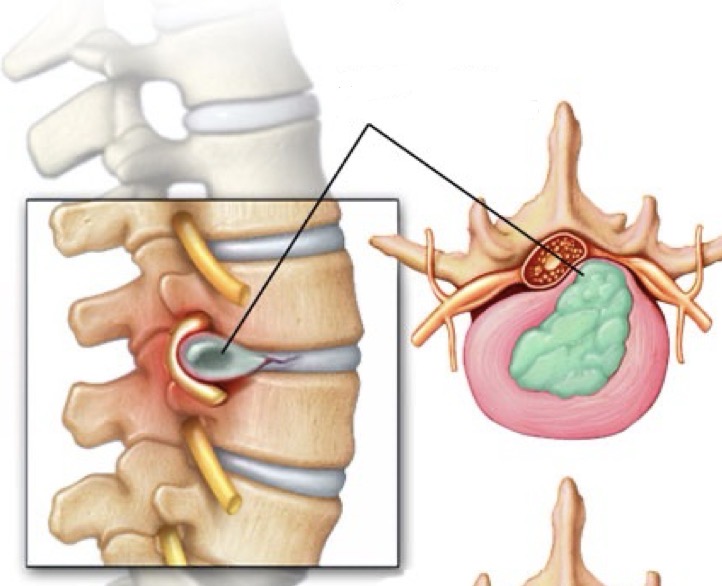 <p>Happens in the lumbar region, the nucleus pulposus ruptures, breaking the annulus fibrosus. Result and pressure on the spinal cord and pressure on the nerves.</p>