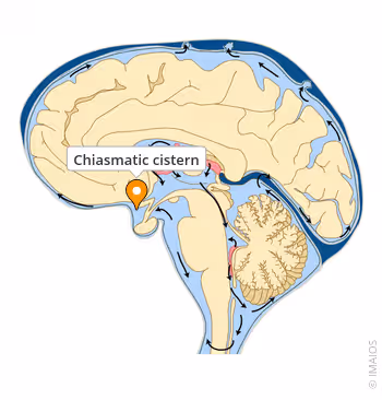 <p>Chiasmatic cistern.</p>