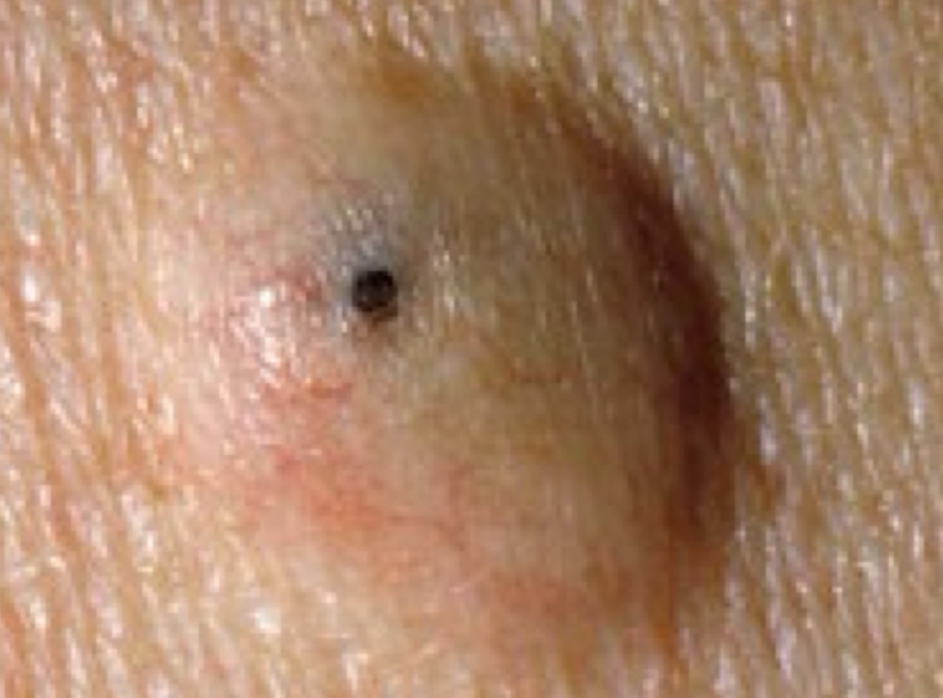 <p>what type of lesion and condition is depicted</p>