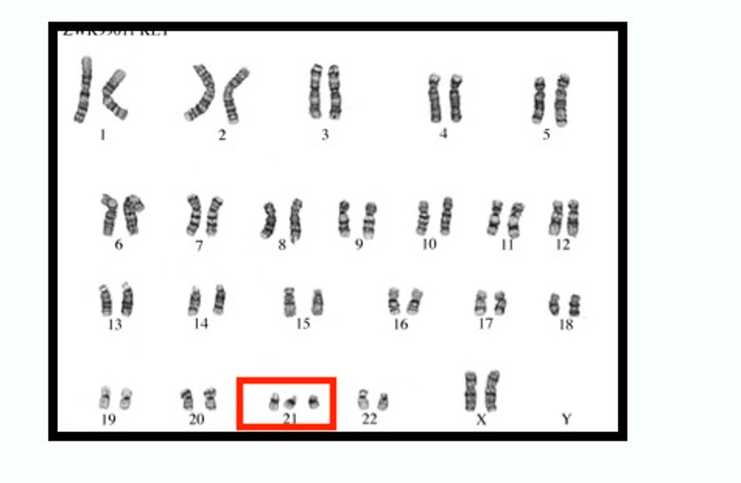 <p>A condition of mild to severe intellectual disability and associated physical disorders caused by an extra copy of chromosome 21</p>