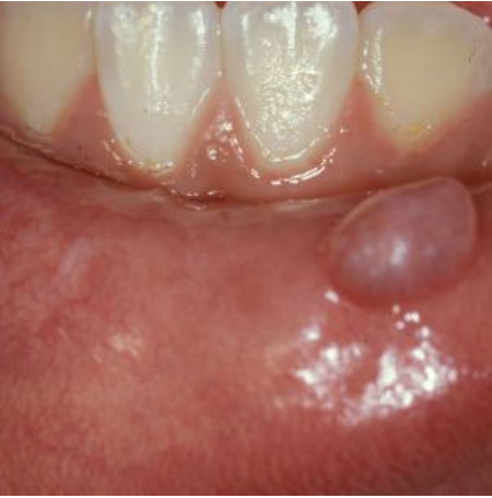 <p>What lesion is this?</p>