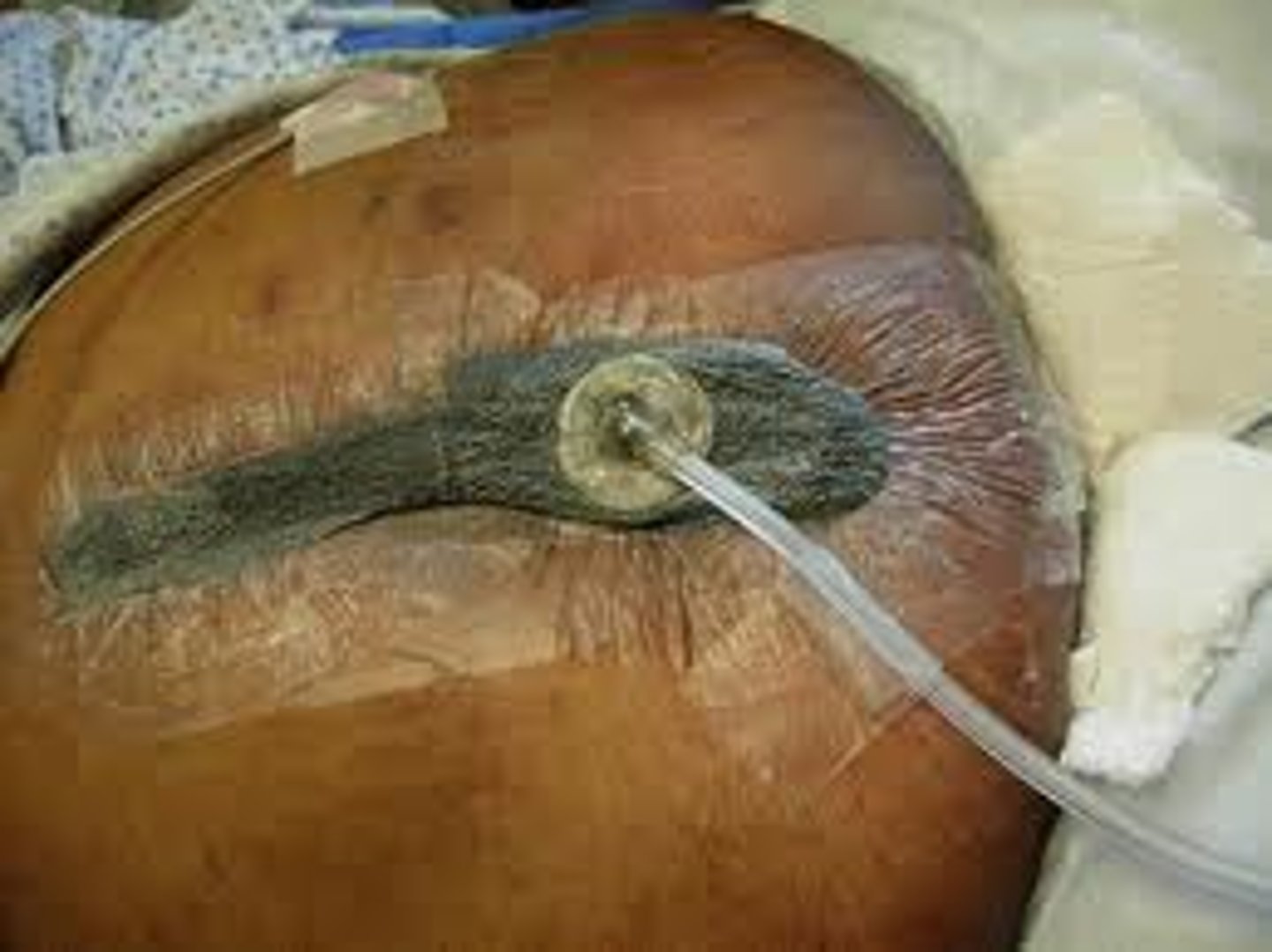 <p>a. Drawing the wound edges together by negative pressure.</p><p>A vacuum-assisted dressing that is accomplished by a special dressing and vacuum device applies negative pressure to the wound, which increases blood flow, increases oxygenation, and improves the delivery of nutrients to the wound.</p>
