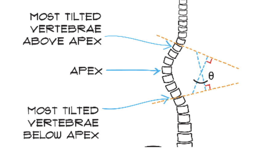 <ol><li><p>Extend lines from the most tilted vertebrae above apex and most tilted vertebrae below apex until they cross</p></li><li><p>Draw a line perpendicular to the top line and a line perpendicular to the bottom line, they should cross and make an X</p></li><li><p>The vertical angle in the X is the Cobb angle:</p></li></ol><p><strong>Top vertebrate is the atlas (C1); The second is the axis (C2)</strong></p>