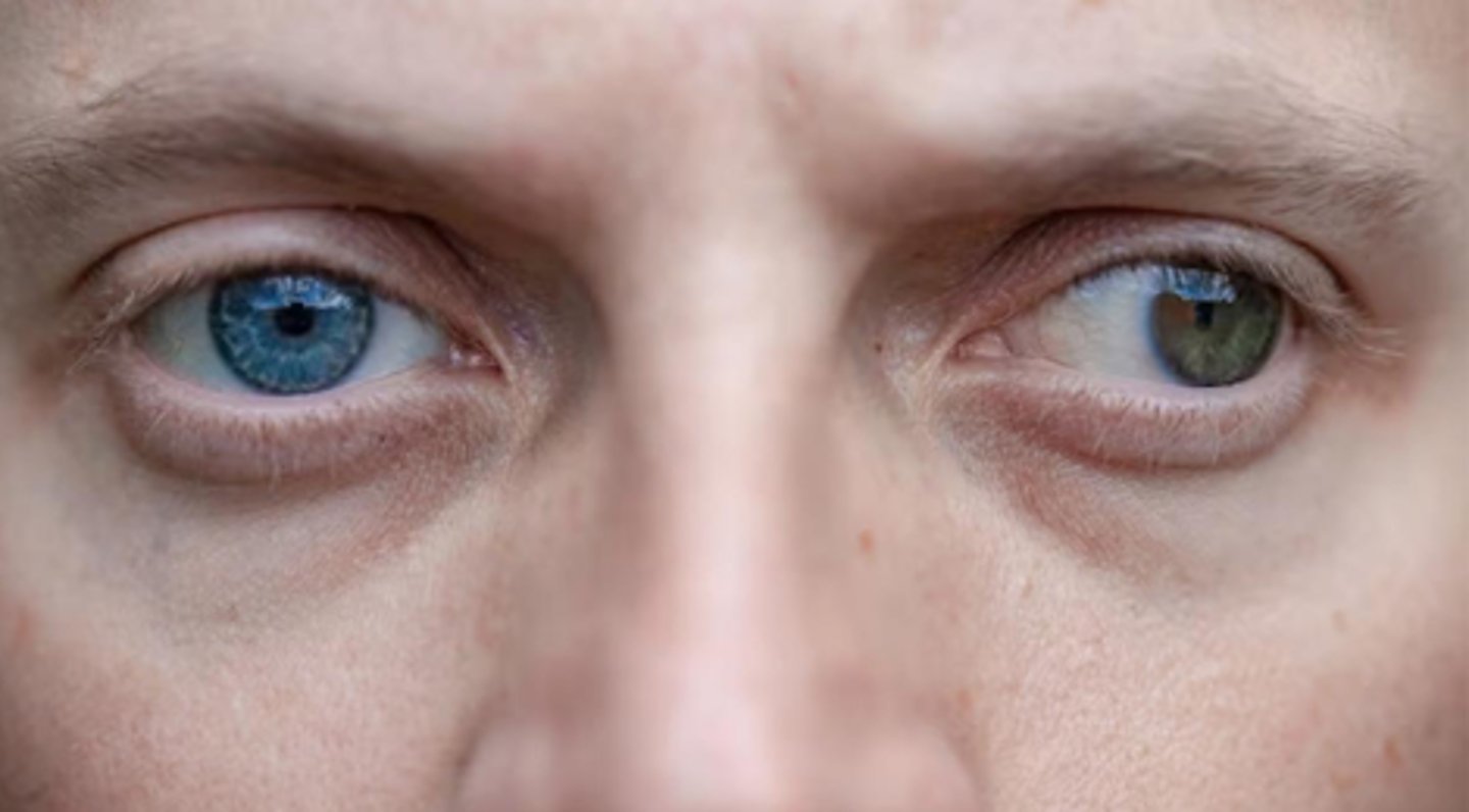 <p>- When binocular vision is disrupted (one eye covered)</p><p>- Brain compensates for misalignment</p><p>- Cover/cover test</p>