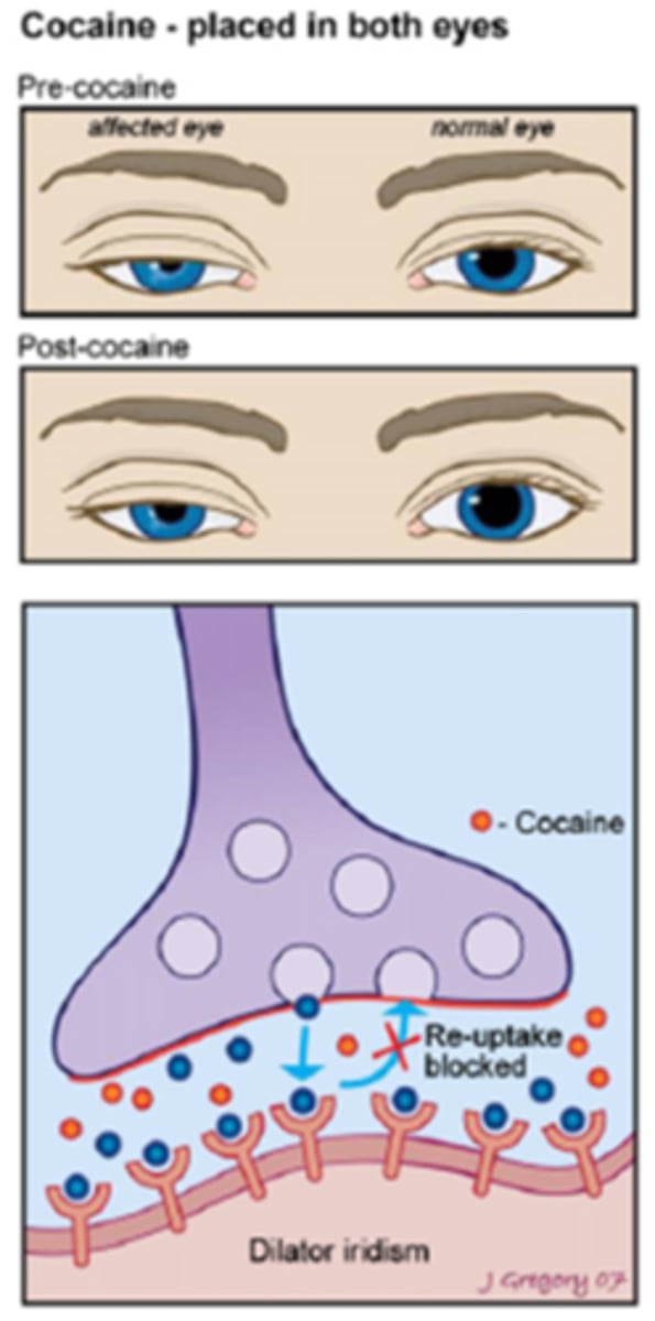 <p>hard to obtain cocaine bc of scheduling status</p><p>inhibits hydroxyamphetamine reuptake so cannot conduct this test later</p><p>may remain in urine up to 2 days after in drug tests</p><p>if symp nerve pathway damaged fron trauma then the test is less sensitive</p><p>dark irises may have a slower response and up to 3 hours before interpreting</p>