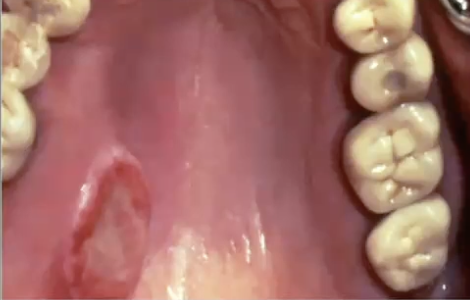 <p>Where might you find polymorphous adenocarcinoma?</p>