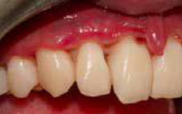 <p><span style="color: blue;"><strong><em><u>SPECIFIC INFECTIONS</u></em></strong></span></p><p>Necrotizing Periodontal Disease</p><ul><li><p>Clinical Signs</p></li><li><p>Etiology</p></li><li><p>Treatment</p></li></ul><p></p>