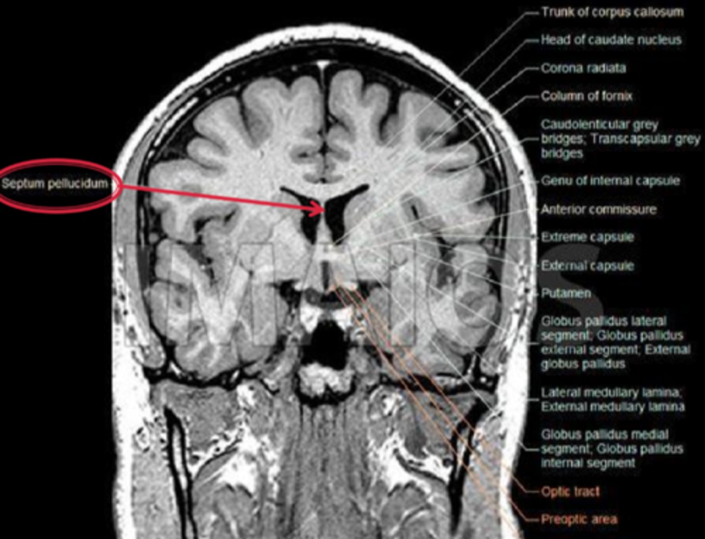 <p>developmental abnormalities like GH deficiency, hypothyroidism</p><p>forebrain anomalies such as lacking a septum pelucidum between the 2 lateral ventricle halves</p>