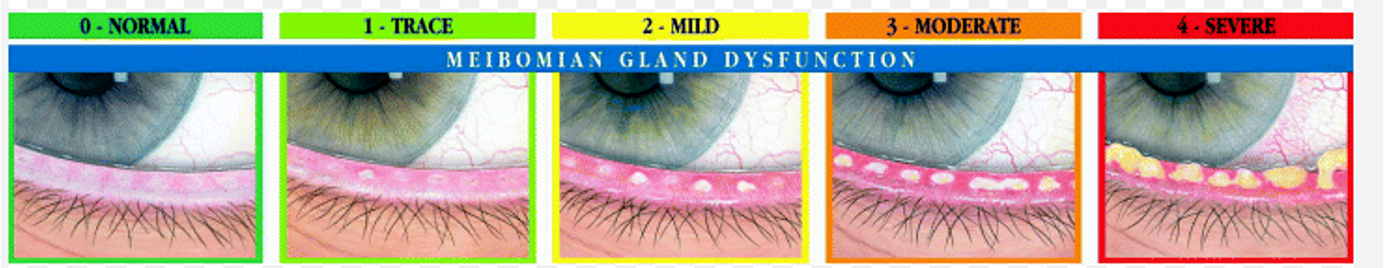 <p><strong>Anterior</strong> - involves the eyelids and lashes and is usually caused by bacterial overgrowth in this area. This type is associated with crusty lashes and styes. </p><p></p><p><strong>Posterior</strong> - aka Meibomian gland dysfunction. This type is associated with a blockage of the Meibomian glands (graded 0-4) preventing formation of a stable tear film and leading to dry eye. </p>