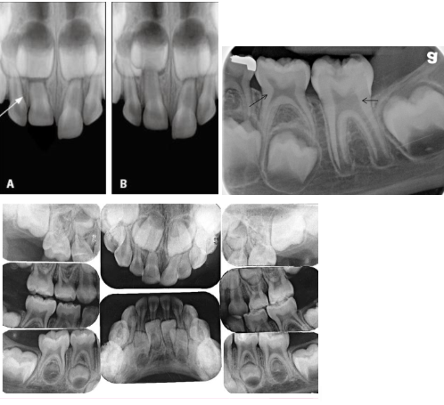 <p><span> As a permanent tooth develops, the root length increases and it moves into position by “pushing out” the primary tooth </span></p><p><span> While this is happening, the primary tooth root starts to resorb and shorten </span></p><p><span> What is happening in this radiograph? </span></p><p><span><strong> Primary molars </strong></span></p><ul><li><p><span>Flared roots </span></p></li><li><p><span>Resorption<strong> </strong></span></p></li></ul><p><span><strong> Permanent molars </strong></span></p><ul><li><p><span>Straighter, longer roots<strong> </strong></span></p></li><li><p><span>Roots still forming </span></p></li><li><p><span>Apical foramen open &amp; wide<strong> </strong></span></p></li></ul><p><span><strong>Follicular space </strong></span></p><ul><li><p><span>RL area surrounding developing tooth </span></p></li><li><p><span>Normal<strong> </strong></span></p></li></ul><p></p>