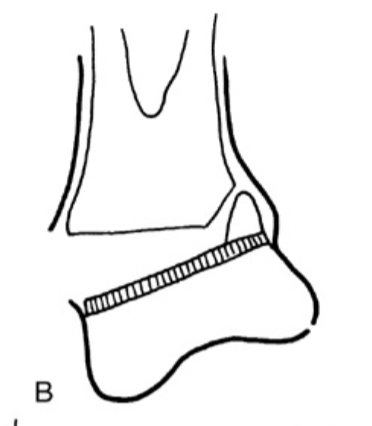 <p><strong>What type of Salter Harris fracture is the following:</strong></p><p>fx of Physis plate w/ Metaphysis fragment </p><p>*MC</p>