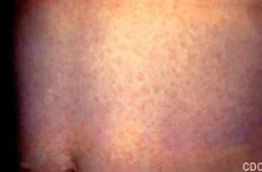 <ul><li><p>an example of an infective teratogen</p></li><li><p>results in cataracts, cardiac defects, and deafness</p></li></ul><p></p>