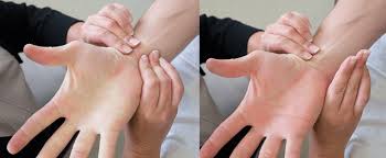 <p>Performed before radial artery puncture to confirm adequate collateral circulation.</p>