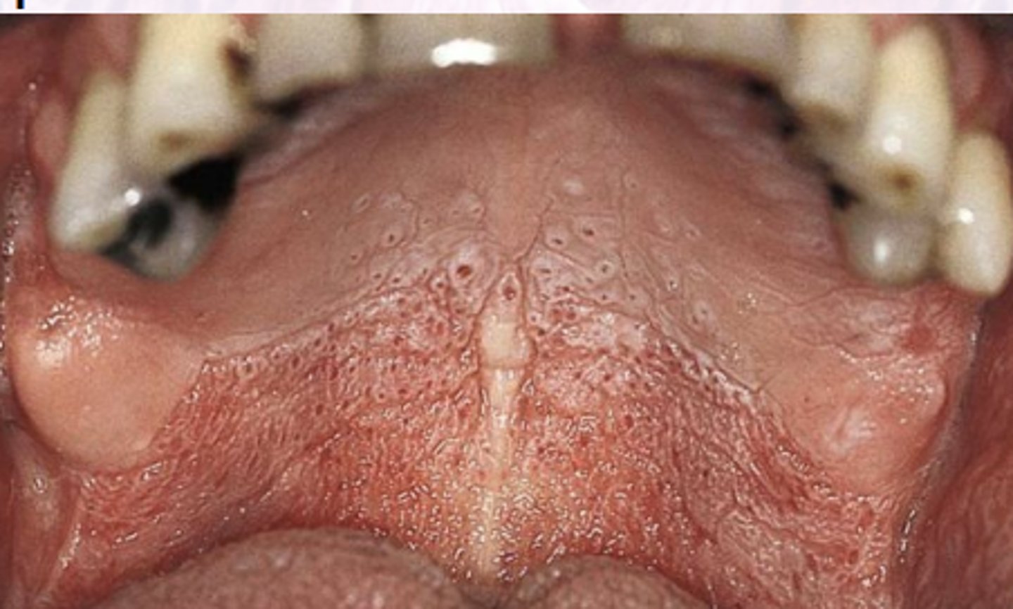 <p>White change of hard palate</p><p>Associated with smoking</p><p>Response to heat (chronic drinkers of hot drinks)</p>