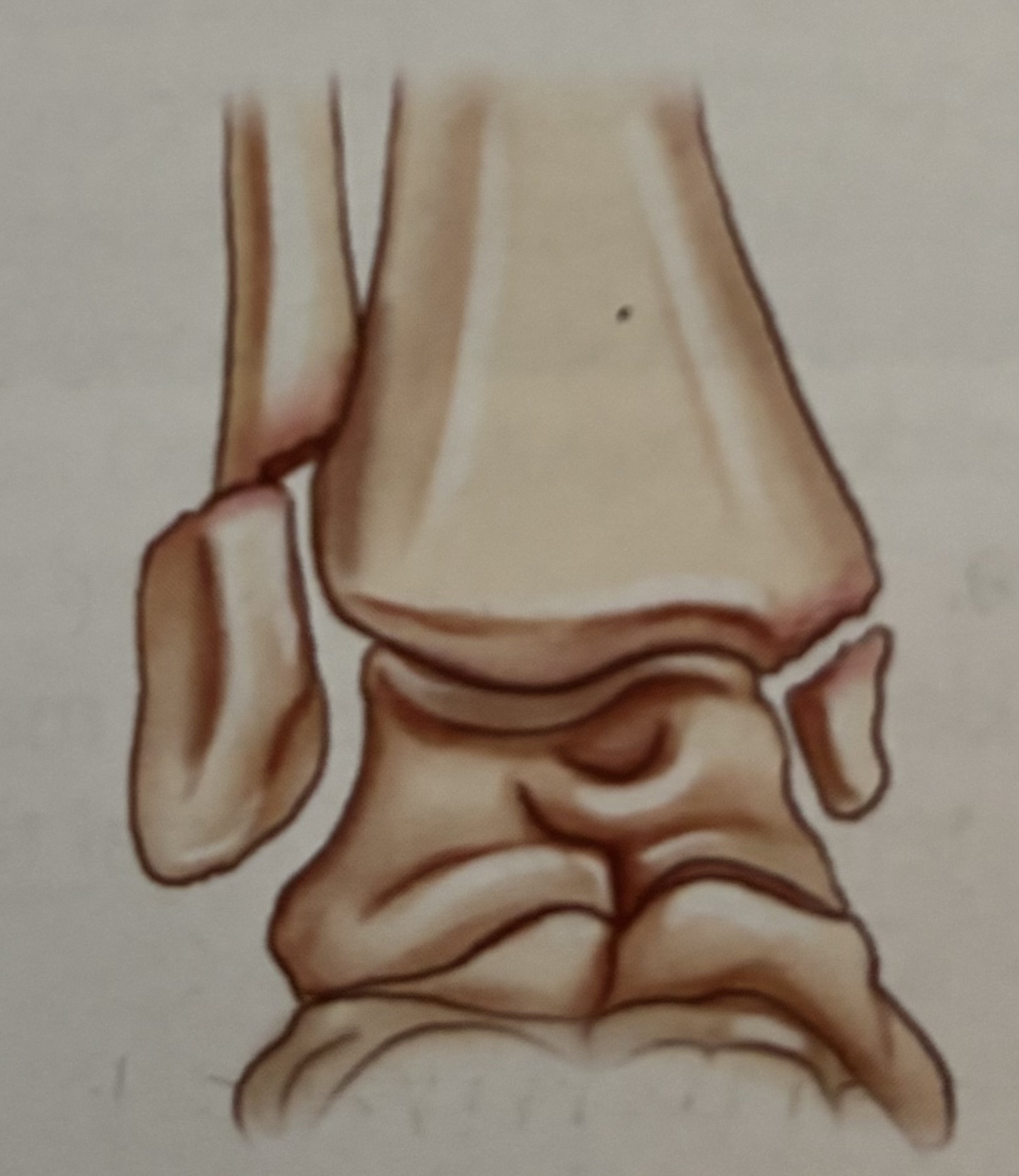 <p>What type of fracture is this?</p>