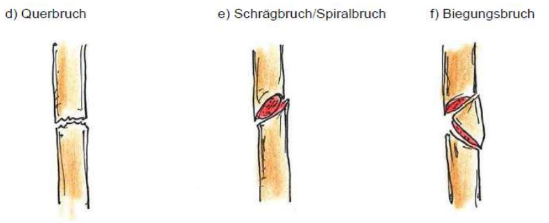<p>d) Querbruch</p><p>e) Schrägbruch/Spiralbruch</p><p>f) Biegungsbruch</p>