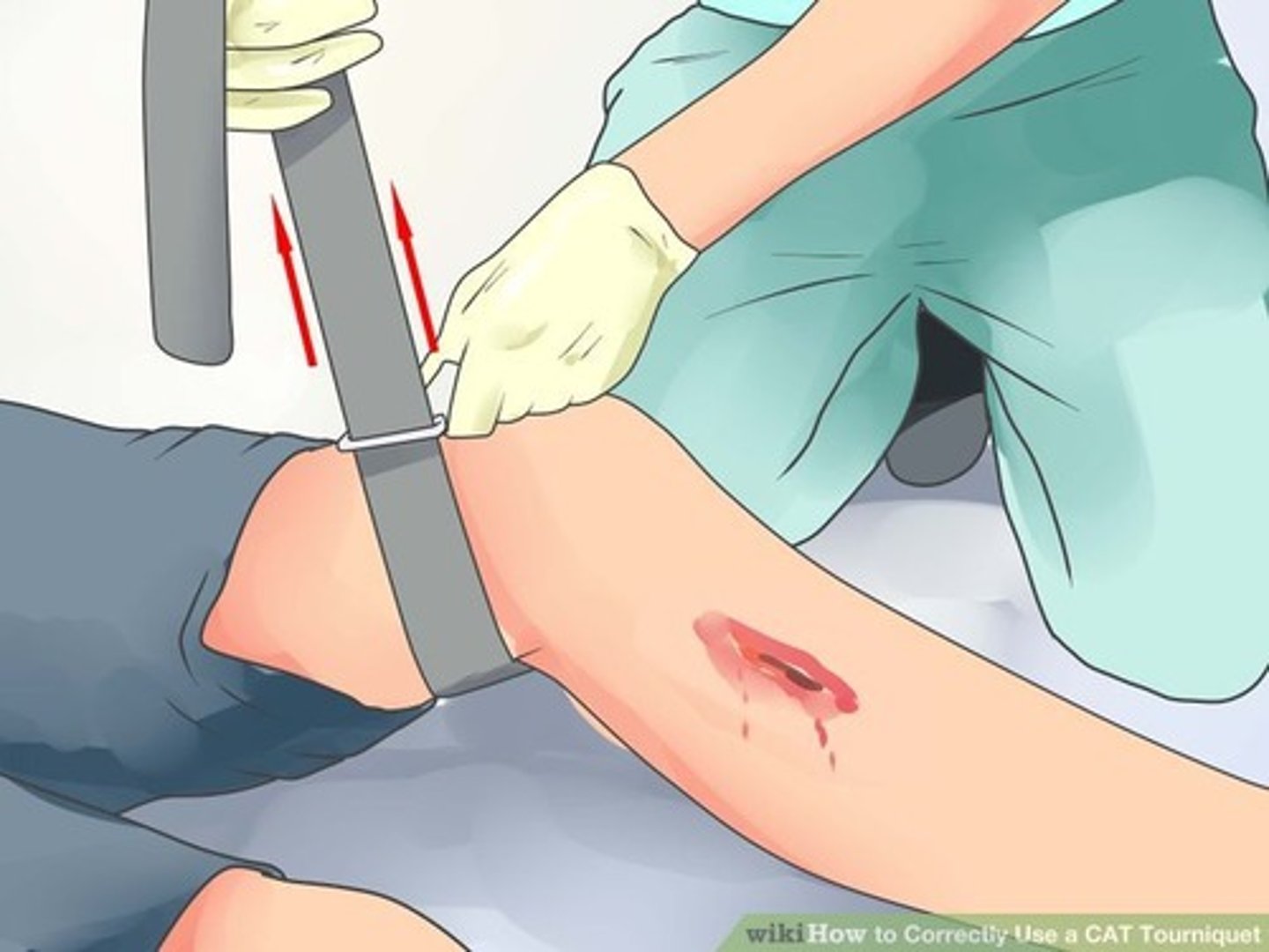 <p>loss of a large amount of blood in a short period of time. If a limb is bleeding, a tourniquet can be applied.</p>