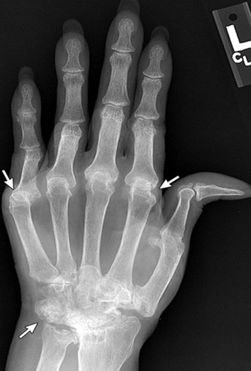 <p>WRIST! Loves to attack the carpals and may see ankylosis of the carpals</p>