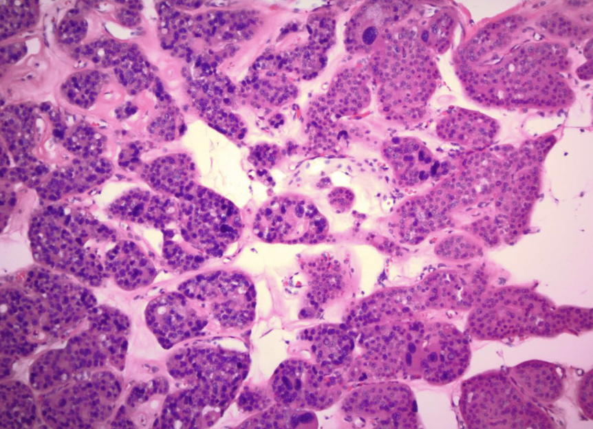 <p>numerous mitochondria = granular eosinophilic cytoplasm</p>
