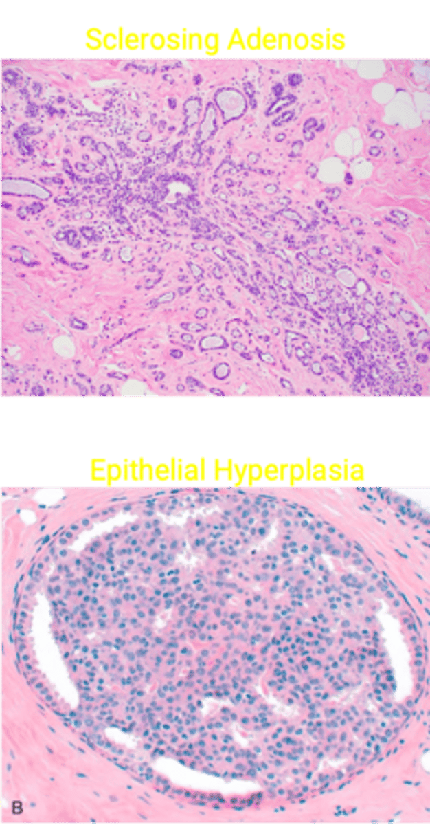 <p>Define Condition:</p><p>MC Benign Breast Lesion - Group of benign breast changes/lesions that have fibrosis or cysts in breast</p><p>-Hx: MC in Premenopausal Women (20-50 y/o)</p><p>-Path: Hormone mediated (cyclic/a/w menstrual cycle)</p><p>-Sx/PE:</p><p>&gt; Lumpy bumpy breast</p><p>&gt; Breast Tenderness</p><p>&gt; Bilateral &amp; Multifocal</p><p>-Prog: </p><p>WITHOUT Atypia --&gt; Slight Inc Risk of Cancer (1.5-2x)</p><p>&gt; Sclerosing Adenosis = Inc number of compressed acinin w/ dense stroma; may have calcifications</p><p>&gt; Epithelial Hyperplasia = Inc luminal/myoepithelial cells in ducts/lobules --&gt; lumen filled w/ cells</p><p>WITH Atypia --&gt; MODERATE Inc Risk of Cancer (4-5x)</p><p>&gt; Atypical Hyperplasia = Epithelial Hyperplasia + Atypia</p>