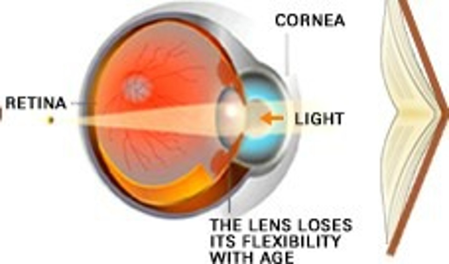 <p>Age-related loss of near vision</p>