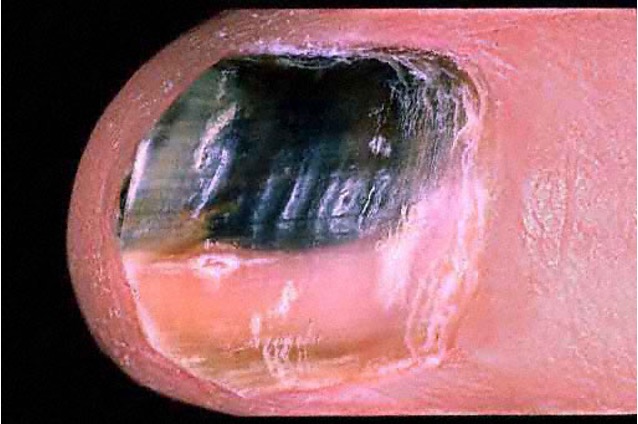 <p>hemorrhage to nail plate</p><p>ex: trauma</p>