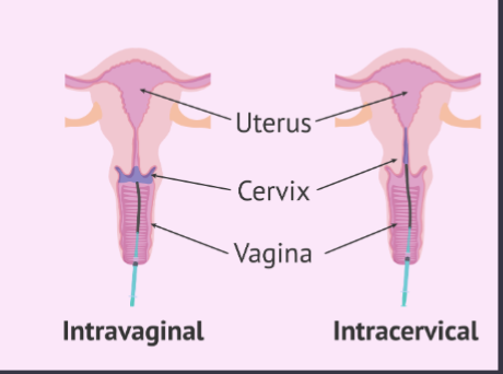 <p>Artificial Insemination in cows, sheep, and goats</p>
